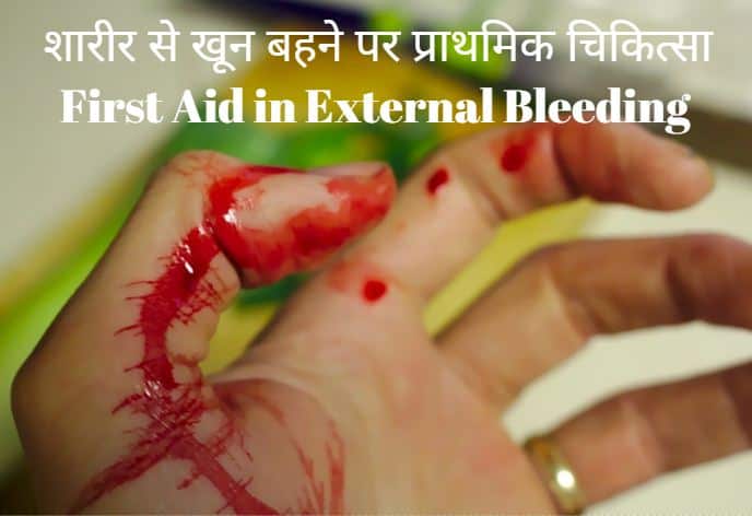 शारीर से खून बहने पर प्राथमिक चिकित्सा First Aid in External Bleeding, first aid in hindi, प्राथमिक चिकित्सा की पूरी जानकारी हिन्दी में First Aid in Hindi [Complete Guide]