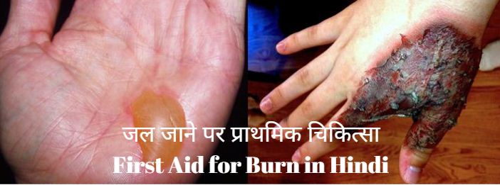 जल जाने पर प्राथमिक चिकित्सा First Aid for Burn in Hindi, first aid in hindi