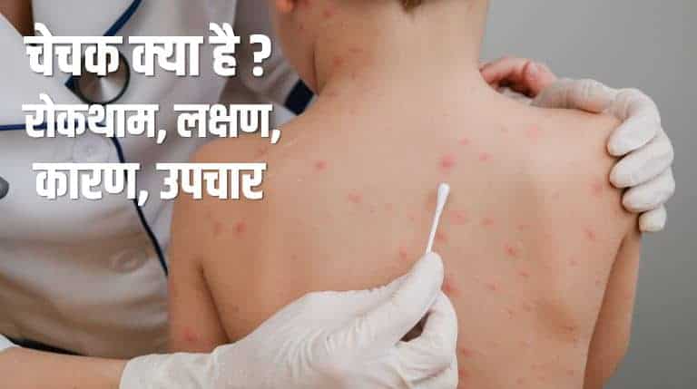 चेचक क्या है? रोकथाम, लक्षण, कारण, उपचार Chickenpox (Varicella) in Hindi