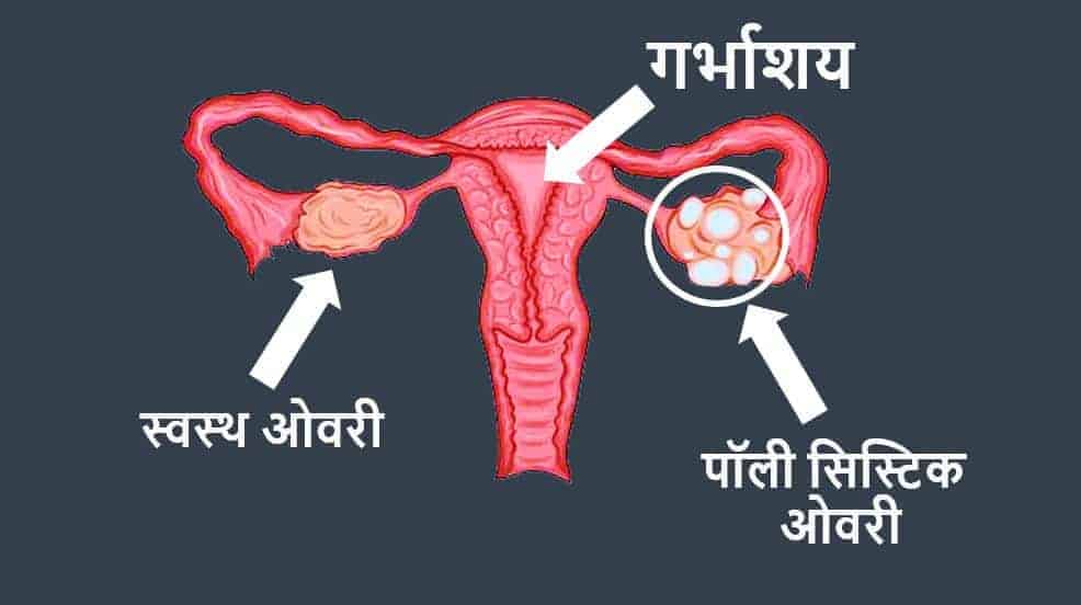 क्या है पॉली सिस्टिक ओवेरियन डिजीज या सिंड्रोम Polycystic ovarian syndrome or disease kya hai,  What is PCOS or PCOD in Hindi ?