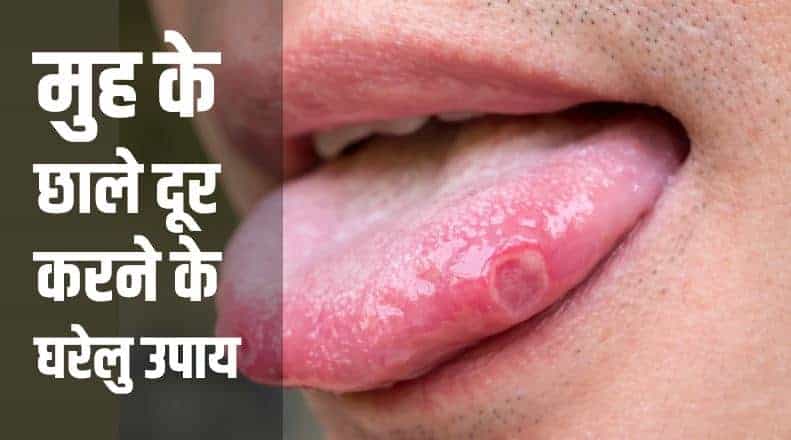 मुह के छाले दूर करने के घरेलु उपाय Home remedies for Mouth ulcer in Hindi
