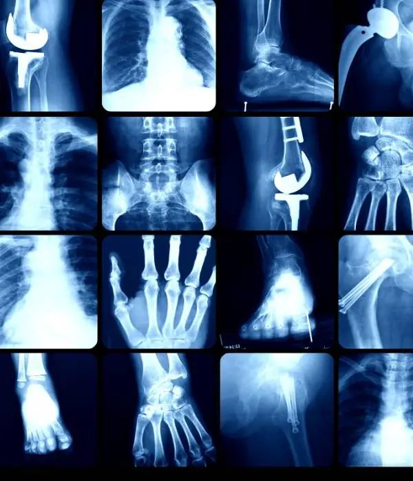 एक्स-रे का आविष्कार (Invention of X-Ray)